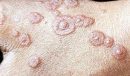 śpiączka afrykańska objawy